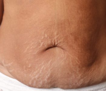 Close up of woman's belly with stretch mark loose lower abdomen skin she fat after pregnancy baby birth, studio isolated, unhealthy belly overweight excess body concept.
